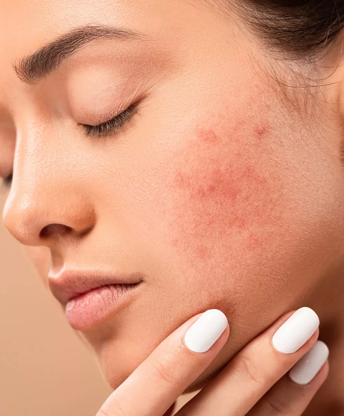 Close-up of woman's skin with acne.