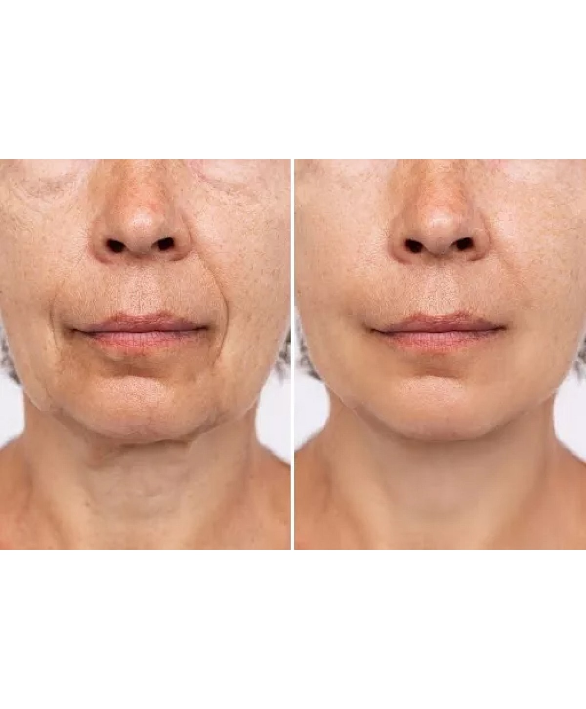 Before and after skin treatment comparison.