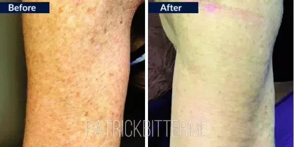 Moxi  Bbl Heroic Before & After