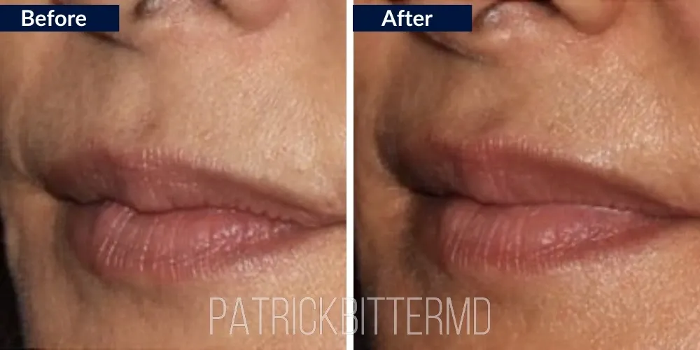 Fillers  Injectables Before & After