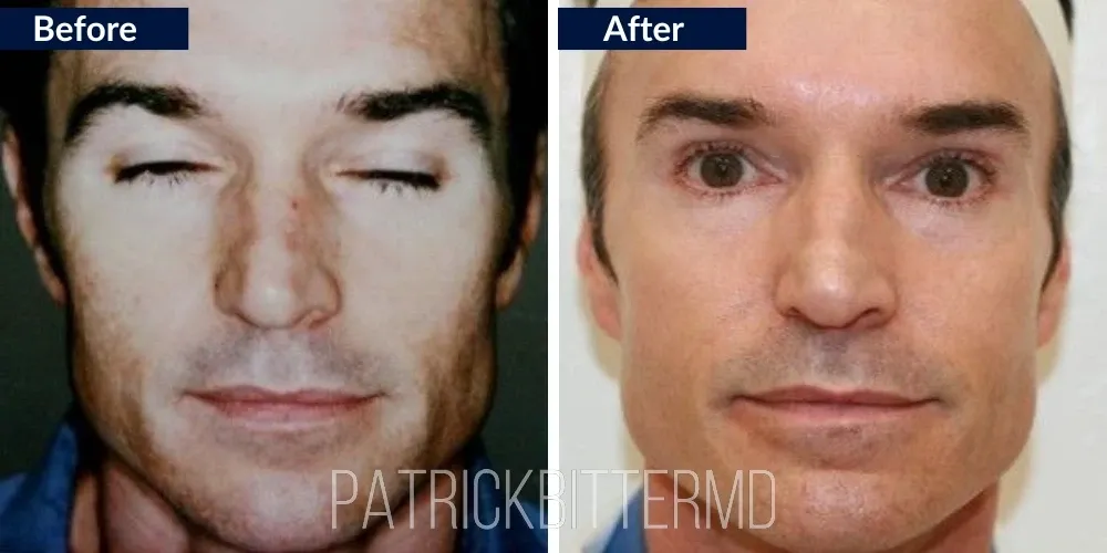 Fotofacial Flawless Facial Before & After