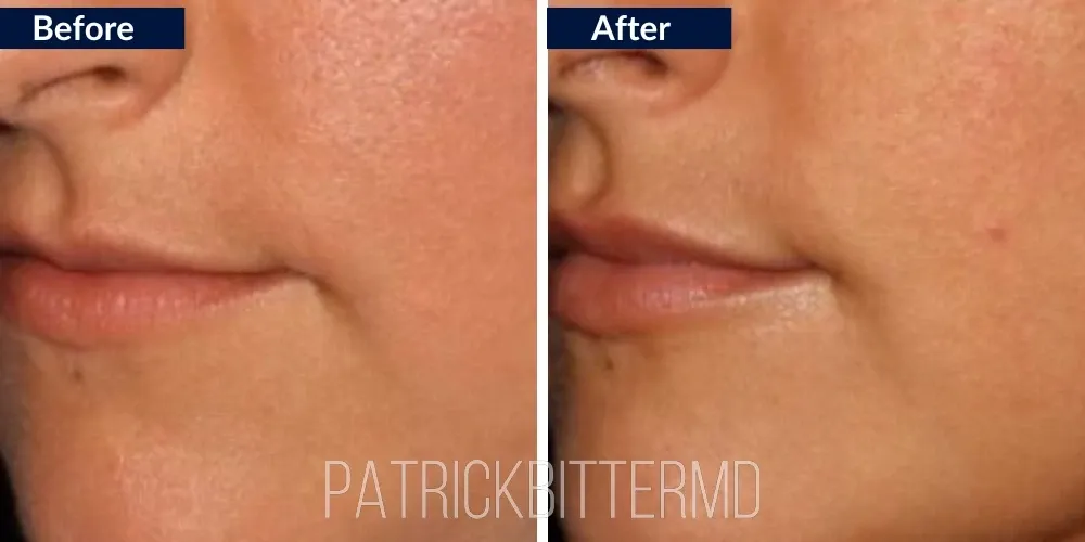 Lips Before & After