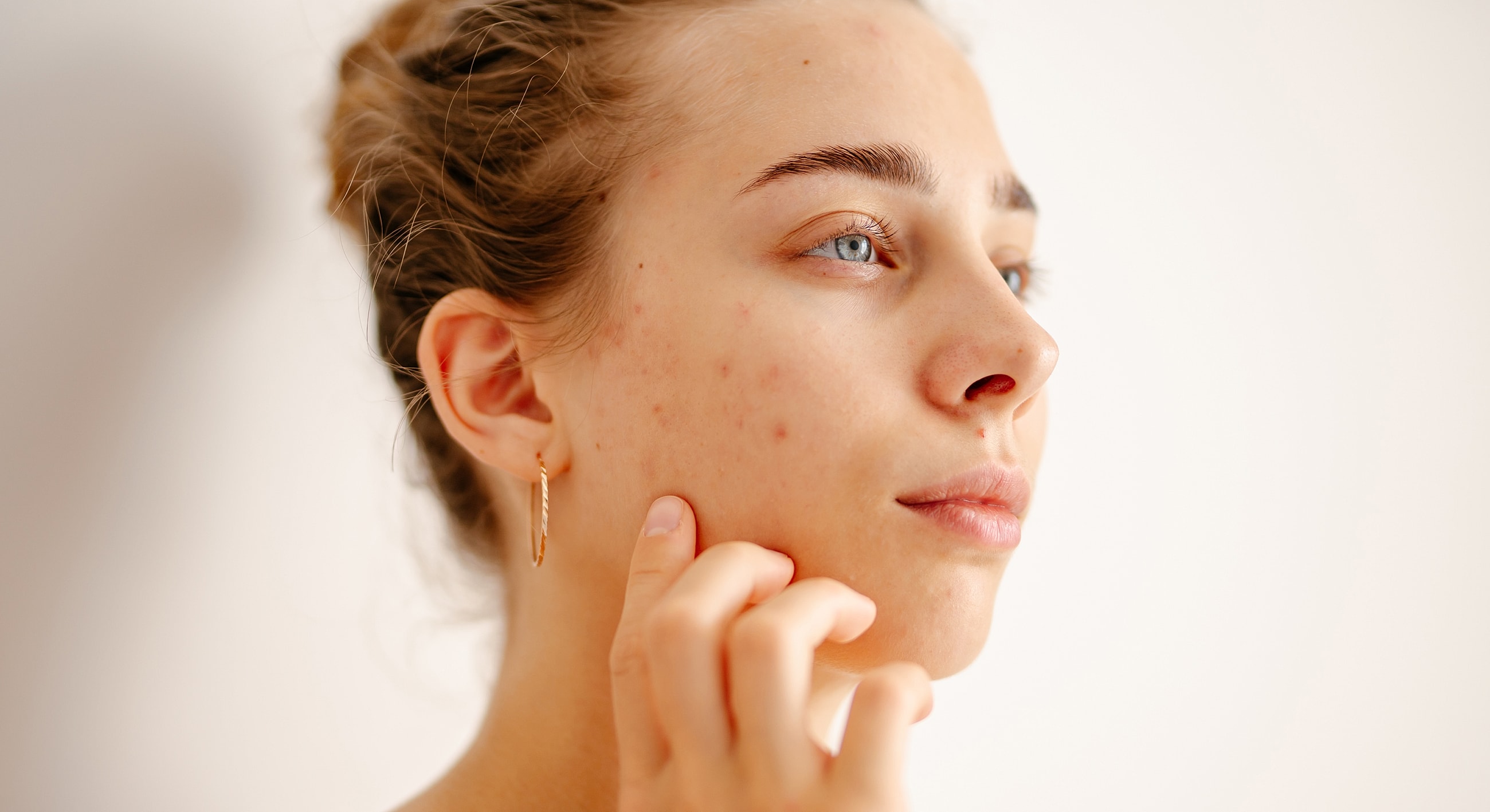 Woman examining her skin with acne scars.