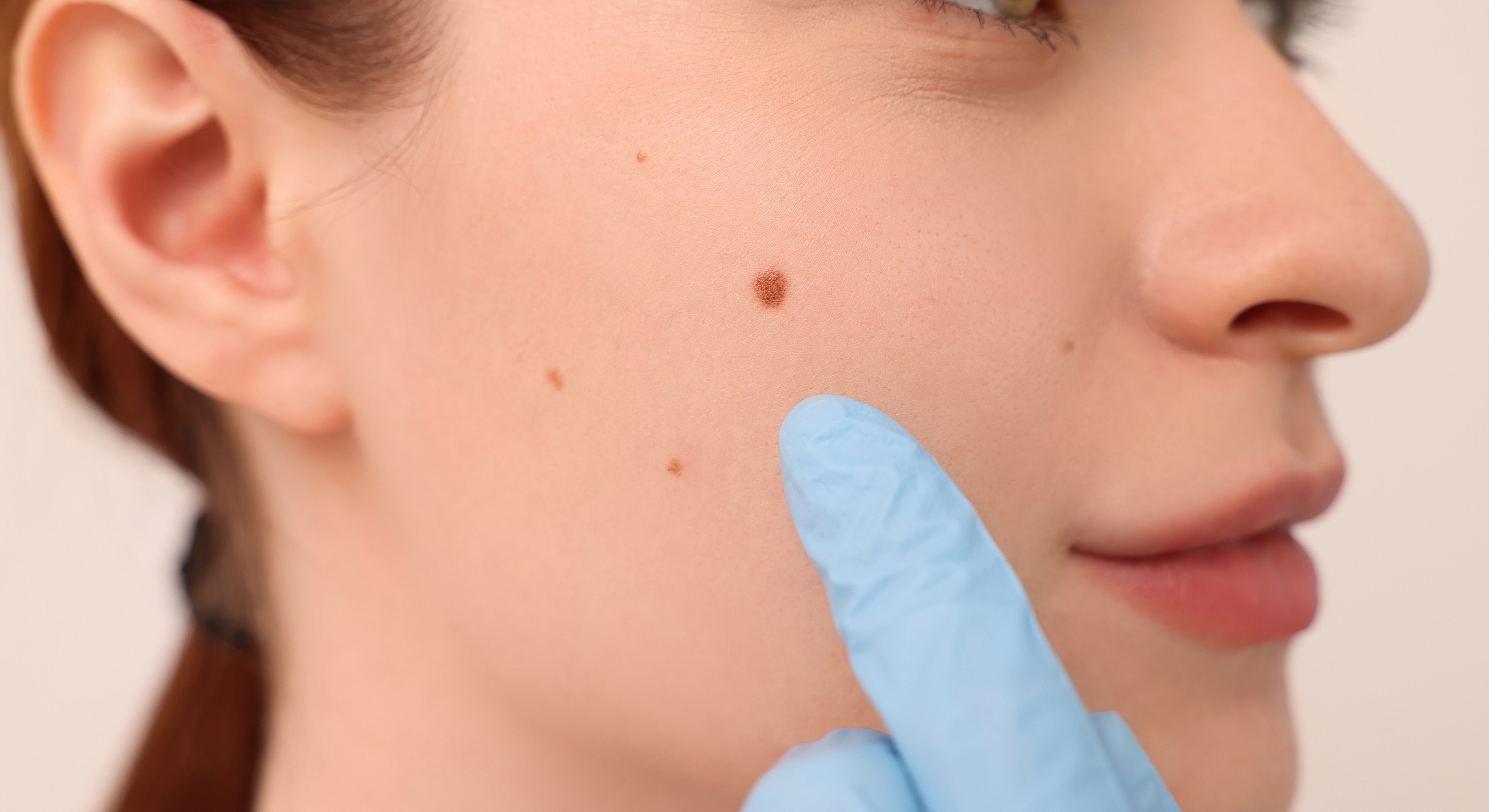 Skin examination for moles and beauty marks.
