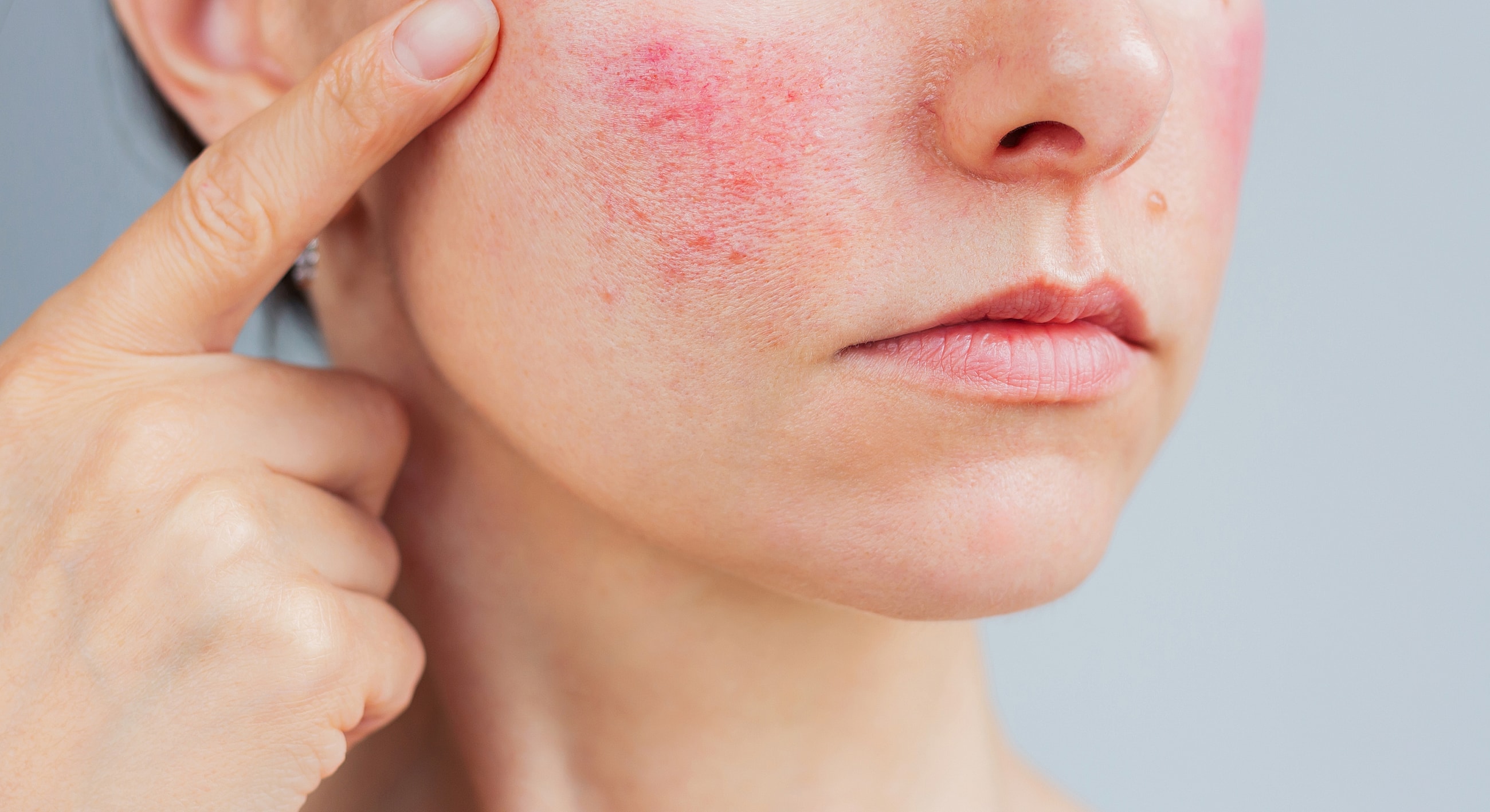 Skin with redness and irritation on the face.