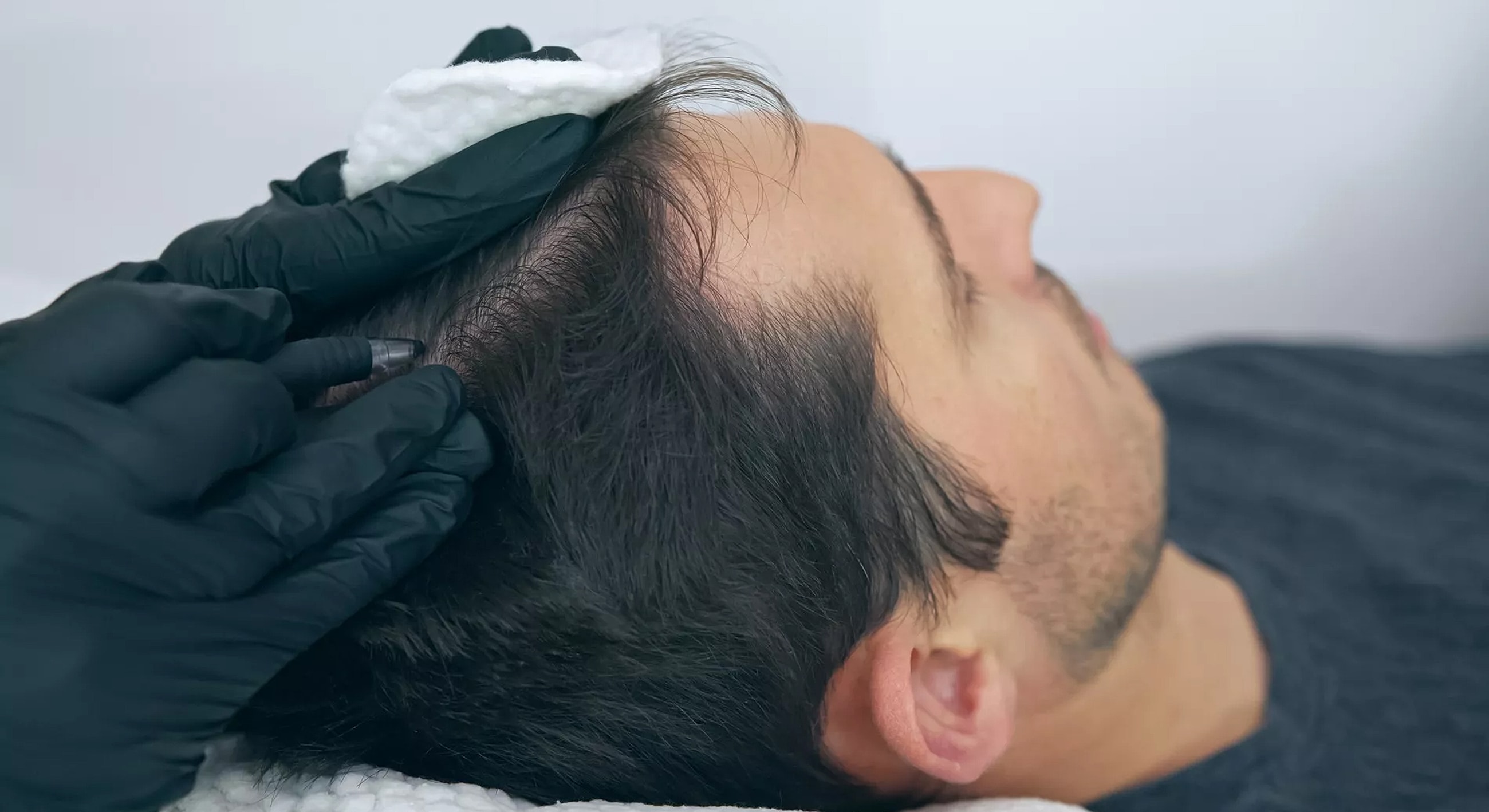 Scalp treatment for hair restoration procedure.
