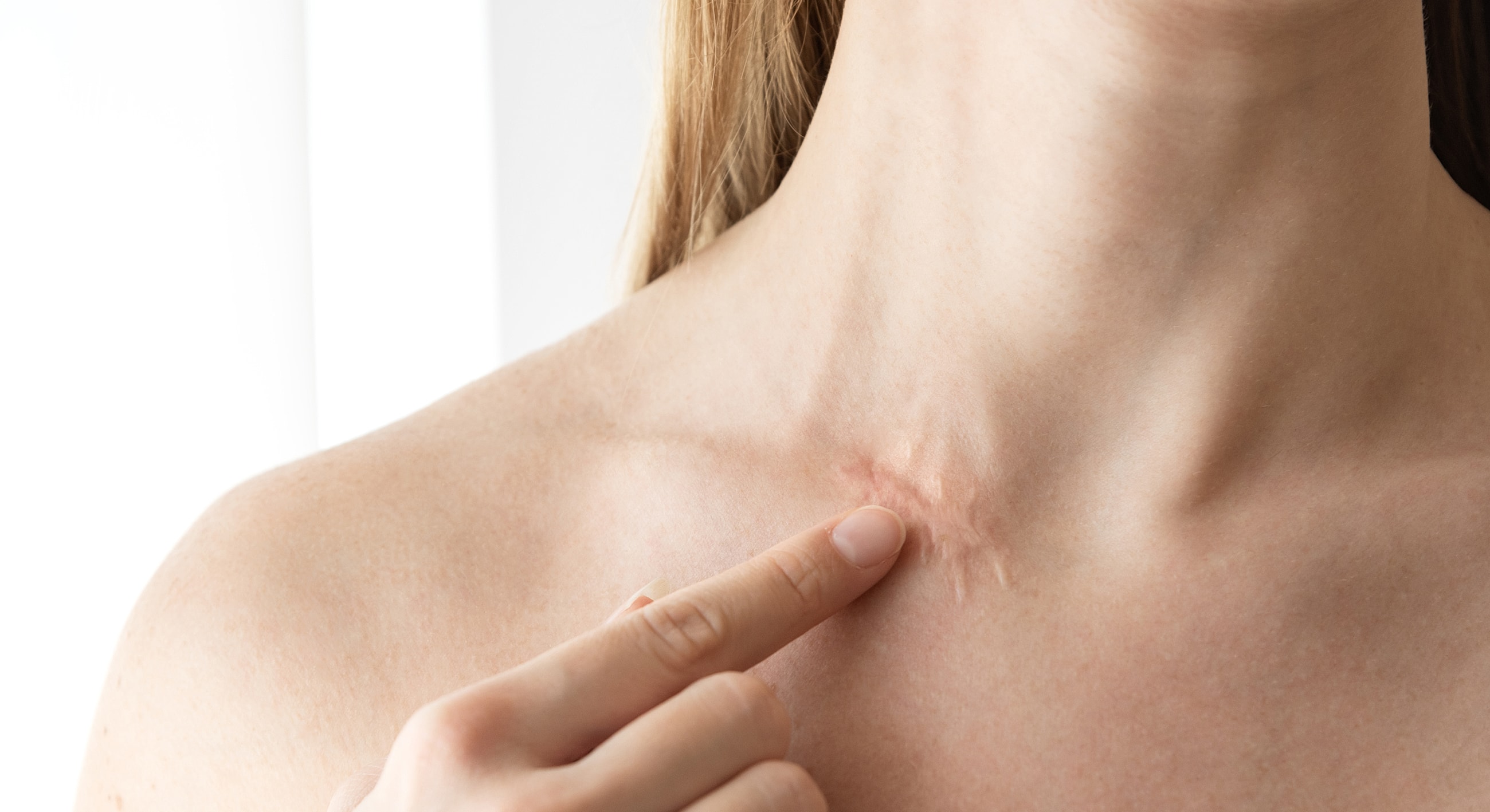 Person pointing at scar on neck.
