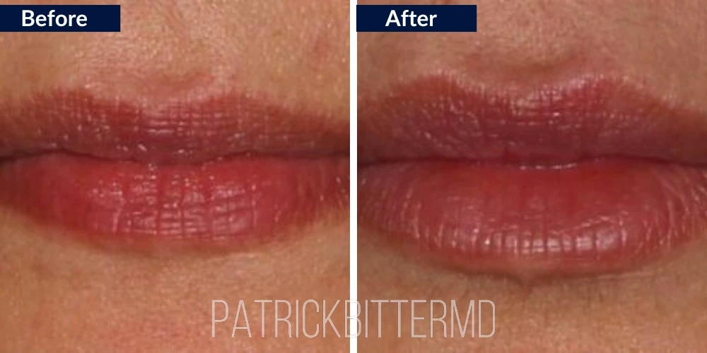 Dr Bitter Lips Augmentation Treatment Before & After