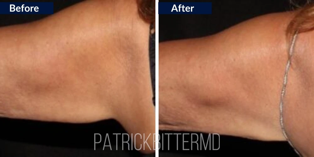 Dr Bitter Body CoolSculpting Treatment Before & After