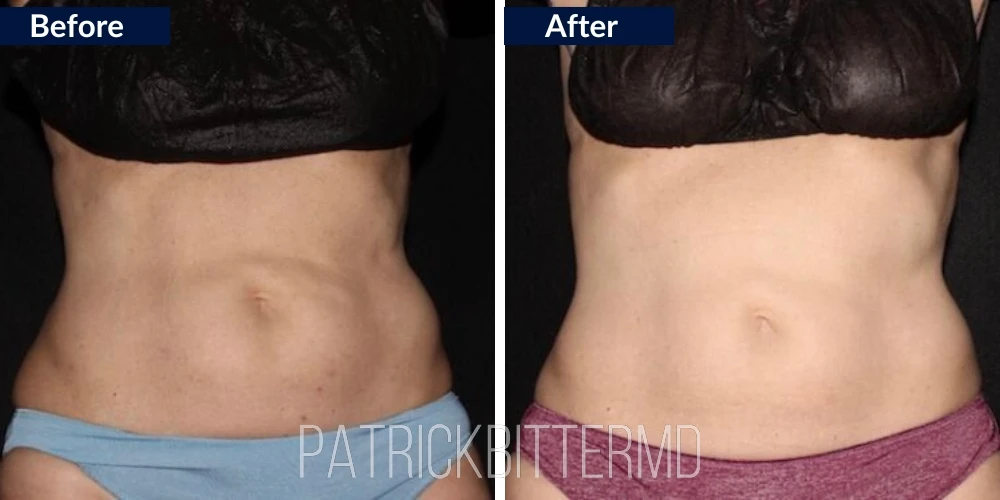 Dr Bitter Body CoolSculpting Treatment Before & After