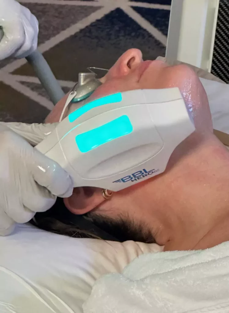 BBL HERO Laser Treatment In LOS GATOS, CA | Patrick Bitter