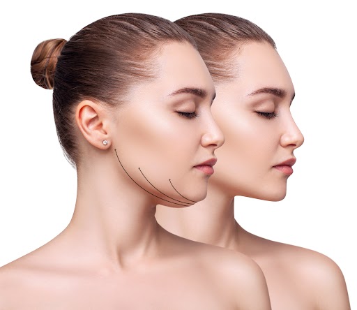 Before & After Jowls Treatment | Patrick Bitter MD in Los Gatos, CA