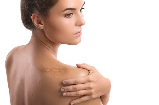 Woman with a scar on her shoulder | Scars In LOS GATOS, CA
