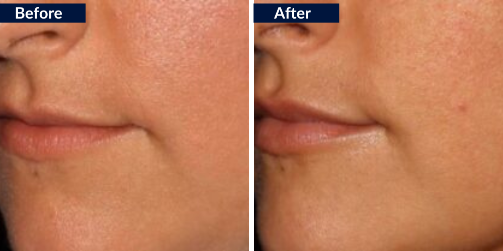 drbittertraining Photos Lips Lip Augmentation b