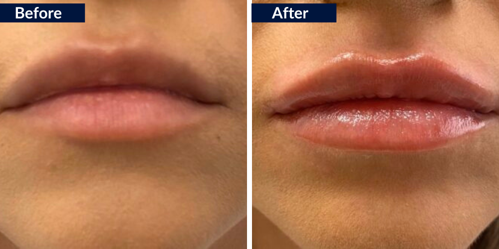 drbittertraining Photos Lips Lip Augmentation e