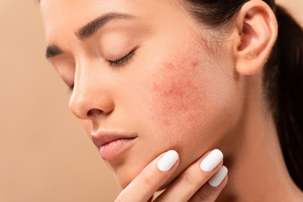 young woman with closed eyes touching face with acne isolated on