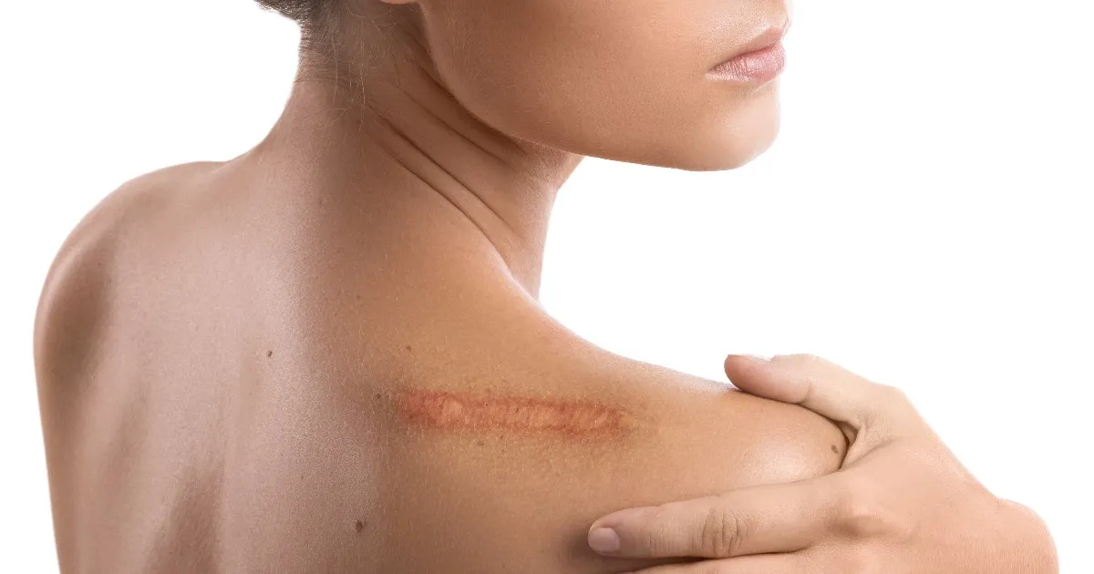 Women receiving Scar treatments in Los Gatos, CA